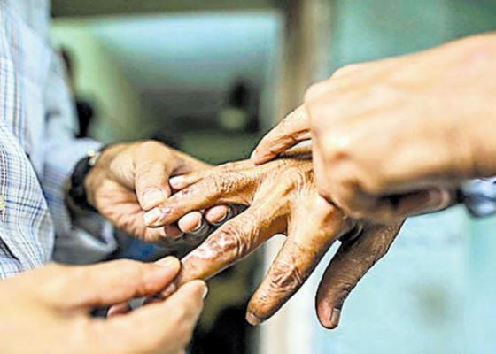 झापामा ५५ जना नयाँ कुष्ठरोगी फेला